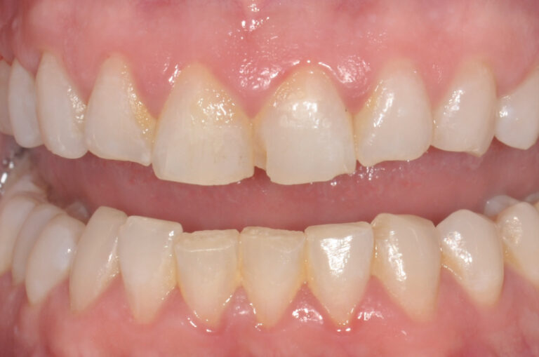 Veneers_4_before